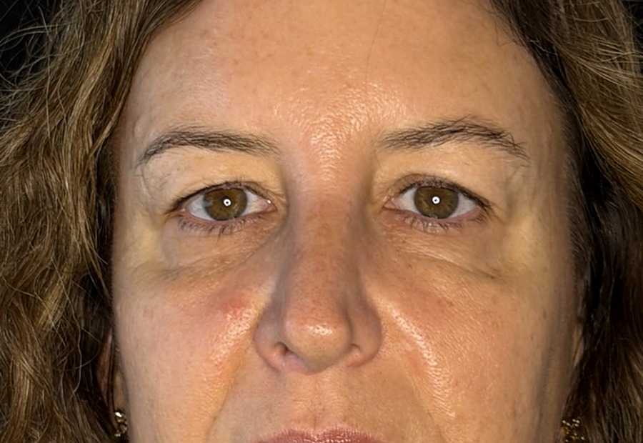 Antes de la blefaroplastia — detalle de la mirada