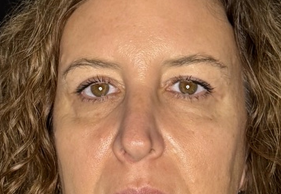 Después de la blefaroplastia — detalle de la mirada