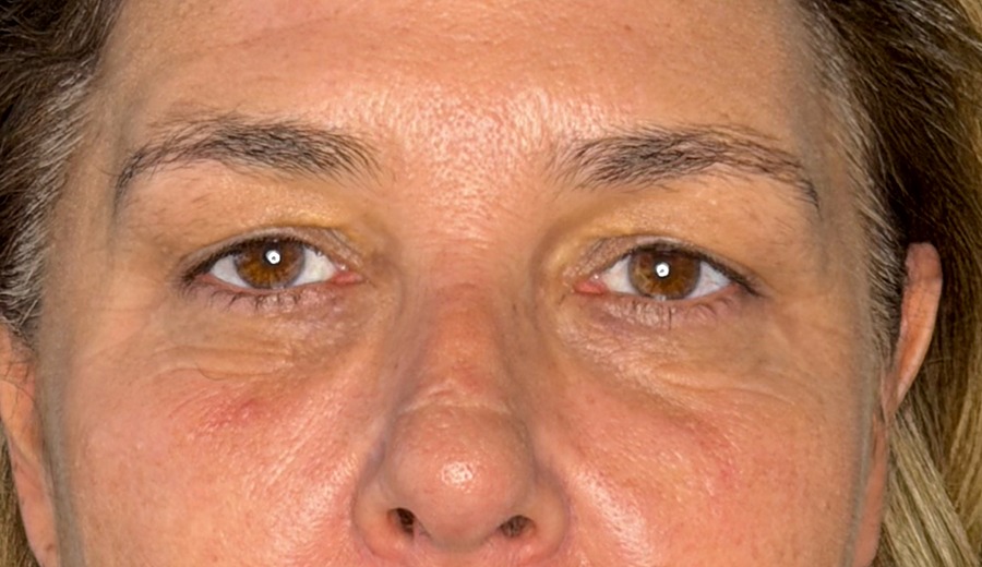 Antes de la blefaroplastia, segundo caso — detalle de la mirada