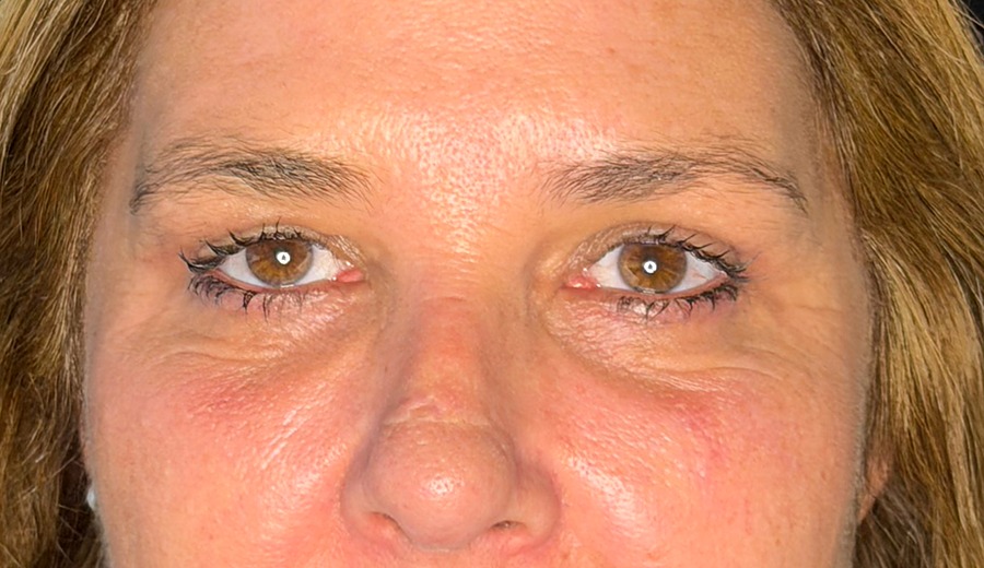 Después de la blefaroplastia, segundo caso — detalle de la mirada