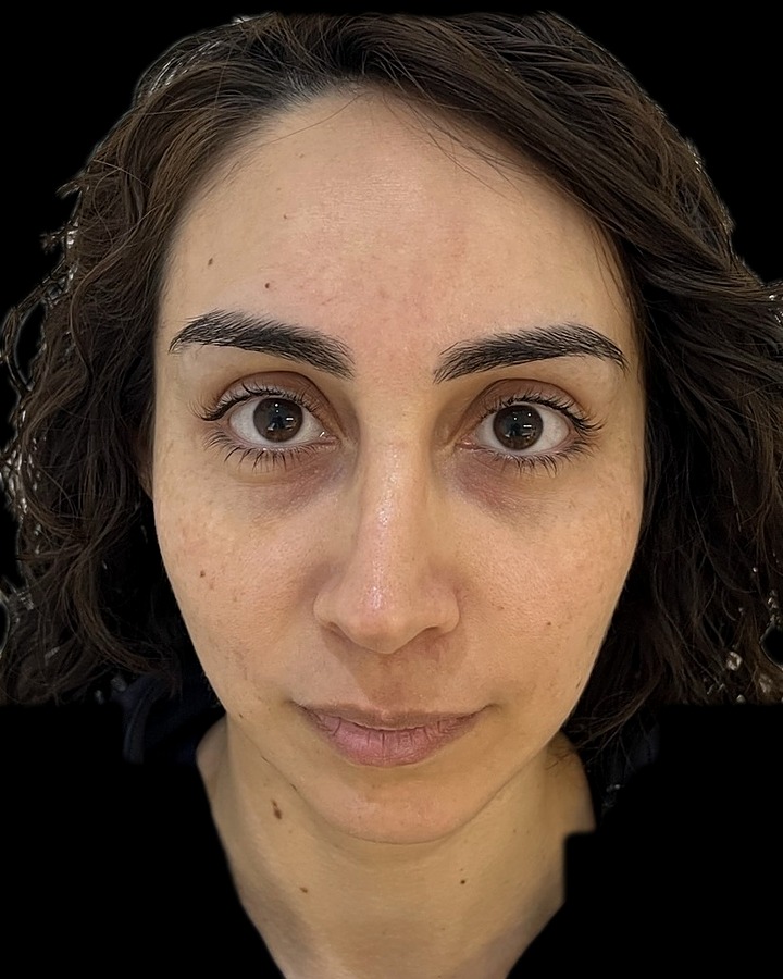 Antes de la armonización facial completa con ácido hialurónico