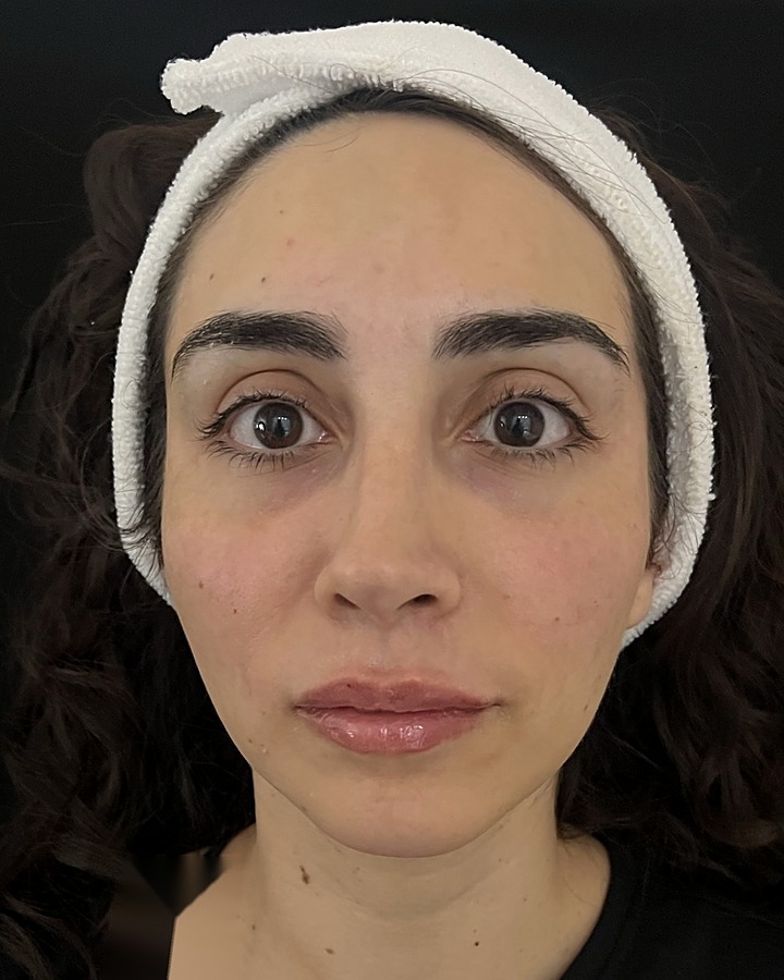Después de la armonización facial completa con ácido hialurónico