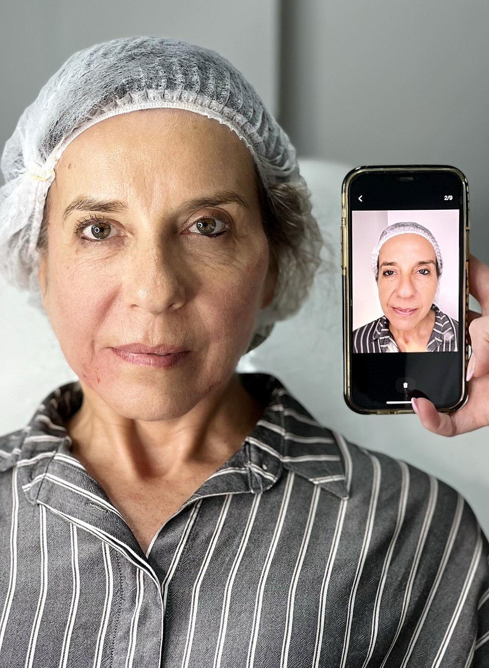 Paciente mostrando su foto previa al tratamiento en el celular, junto a su rostro actual después de los hilos Aptos