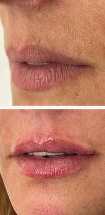 Después del aumento de labios con ácido hialurónico