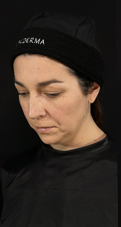 Antes del bioestimulador Sculptra Facial, paciente con descenso de peso por GLP-1