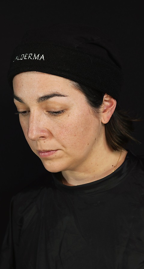 Después del bioestimulador Sculptra Facial, paciente con descenso de peso por GLP-1