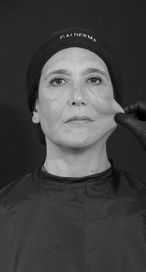 Pinch test día 0, antes del Sculptra Facial