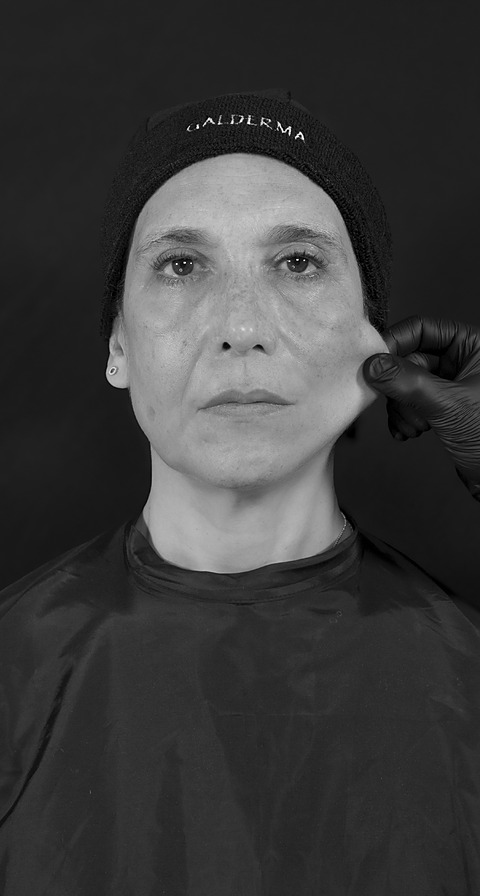 Pinch test día 60 del tratamiento con Sculptra Facial