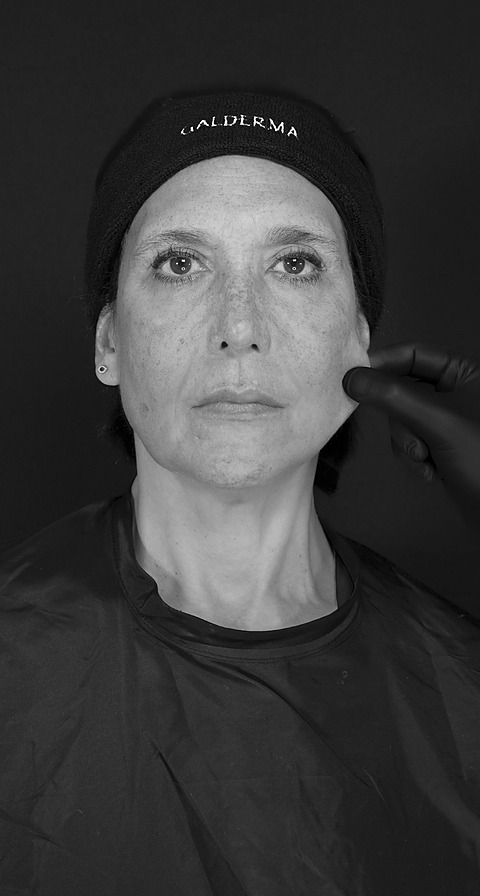 Pinch test día 90, resultado del Sculptra Facial