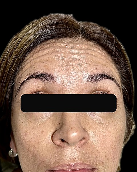 Antes del tratamiento con toxina botulínica — líneas de expresión en la frente