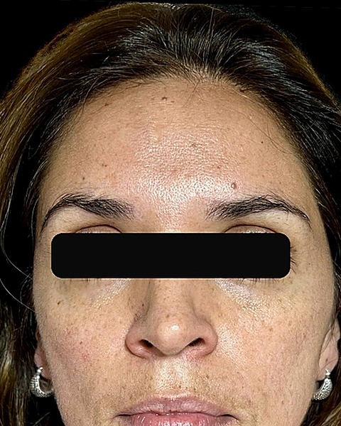 Después del tratamiento con toxina botulínica — líneas de expresión suavizadas